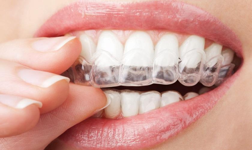 Tìm hiểu về phương pháp chỉnh nha bằng niềng răng Invisalign