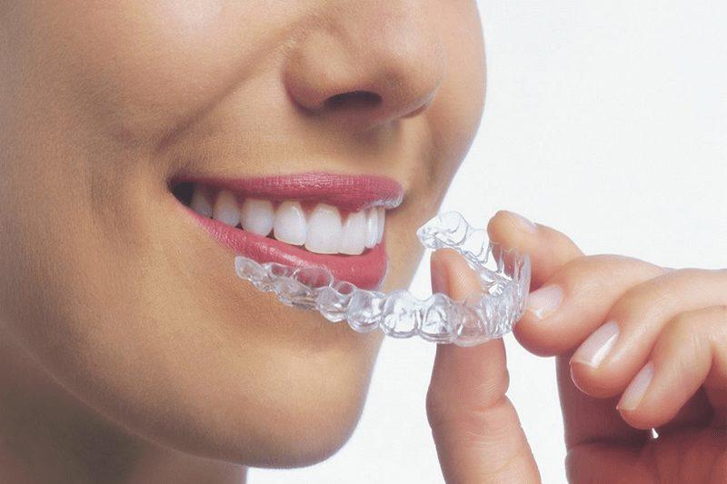 Phương pháp niềng răng trong suốt Invisalign có nhiều ưu điểm vượt trội so với các phương pháp niềng răng khác