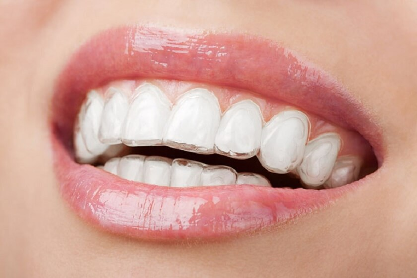 Niềng răng invisalign - công nghệ niềng răng hiện đại từ Hoa Kỳ