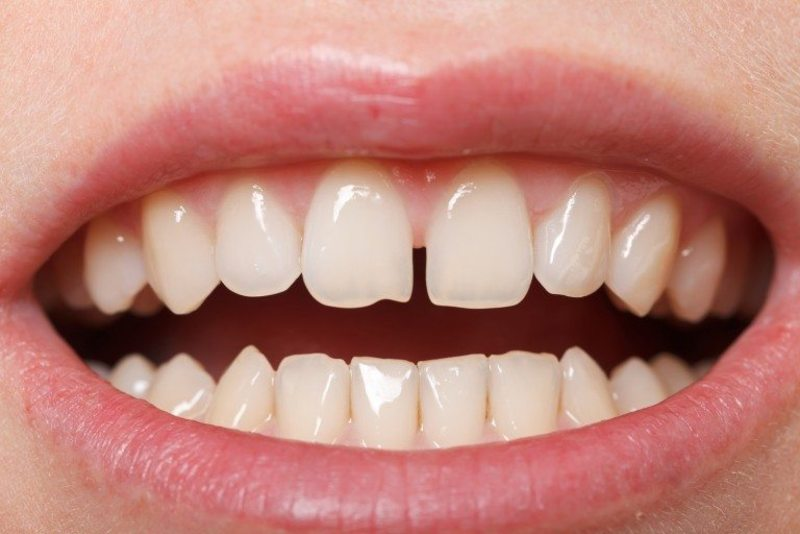 Trường hợp răng thưa thì không cần phải nhổ răng khi niềng Invisalign